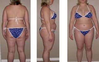 Soboba Medical Weight Loss Clinics Patient